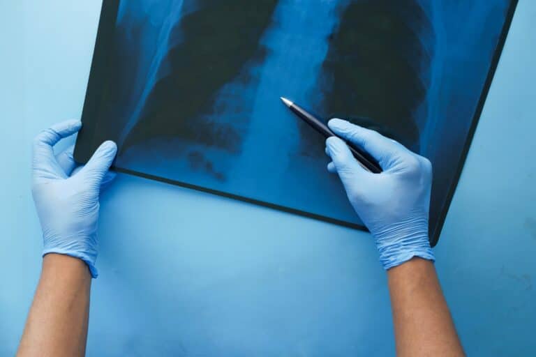 Doctor's hands wearing ppe holding x-ray image scan of bronchiectasis lung blue and black medical diagnostics